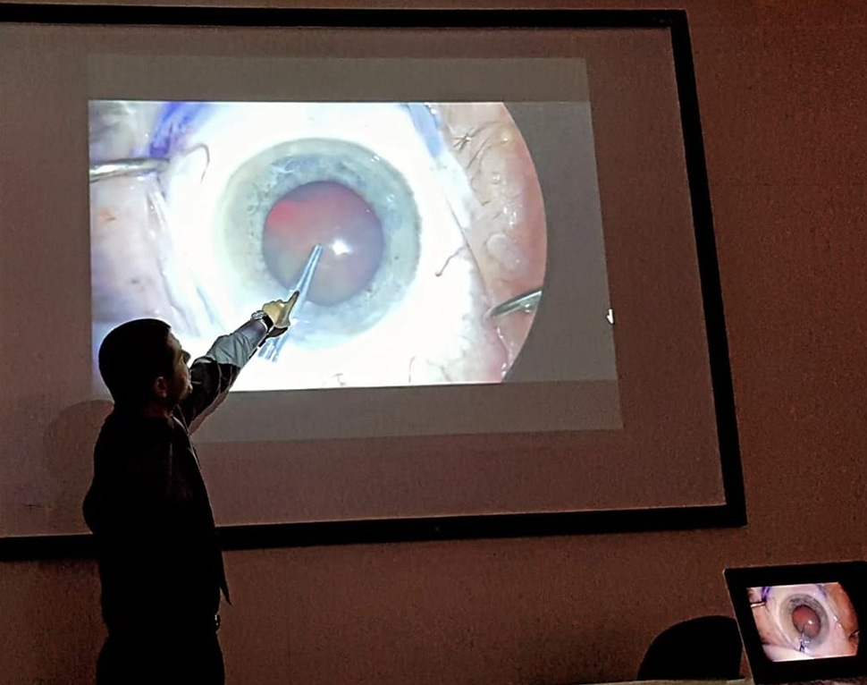 Palestra - A Cirurgia de Catarata Extracapsular & Capsulorhexis - Hospital Universitário de Brasília (HuB-UnB)